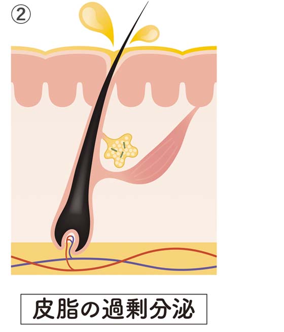 ②皮脂の過剰分泌