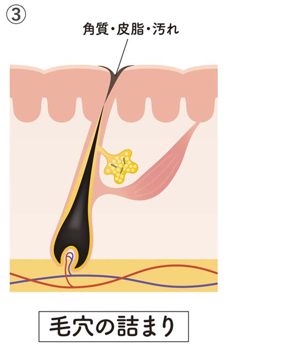 ③毛穴のつまり