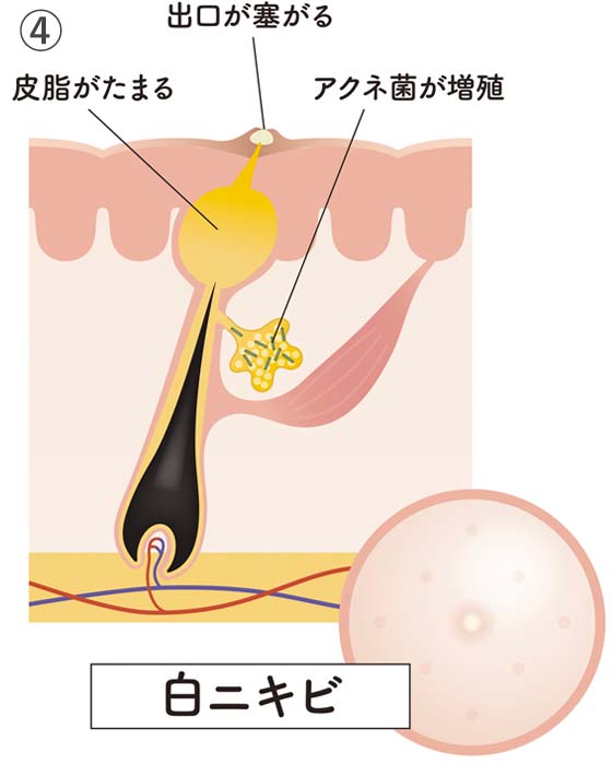 ④白ニキビ