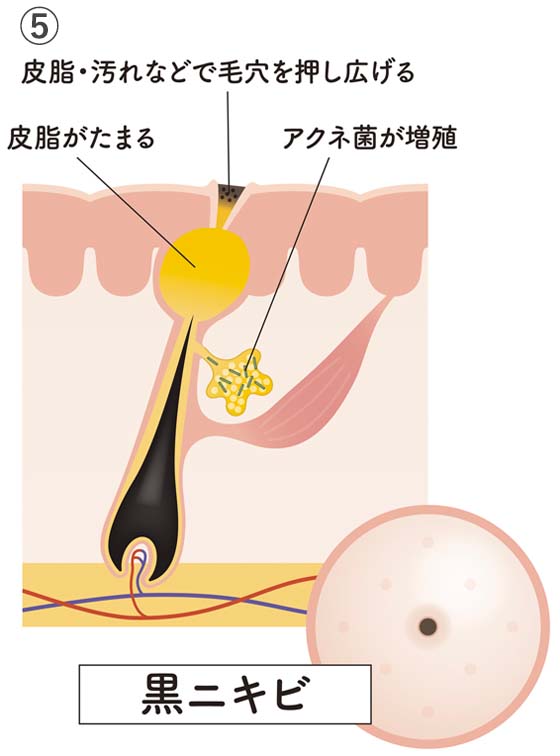 ⑤黒ニキビ