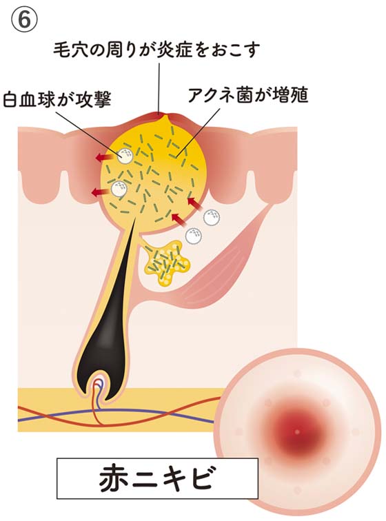 ⑥赤ニキビ