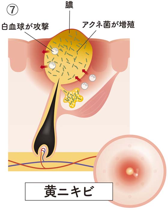 ⑦黄ニキビ
