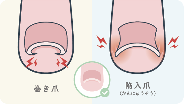 巻き爪・陥入爪の図