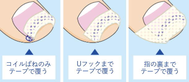 テープで覆う度合の図。コイルばねのみテープで覆う、Uフックまでテープで覆う、指の裏までテープで覆う
